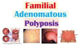 “Colon Cancer That Runs in Families” Familial Adenomatous Polyposis APC Gene Symptoms Treatment [upl. by Ziguard]