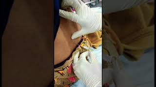 Cerebrospinal fluid CSF collection lumbar puncture procedure [upl. by Nolyak]