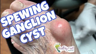 Spewing Ganglion Cyst [upl. by Agnella960]