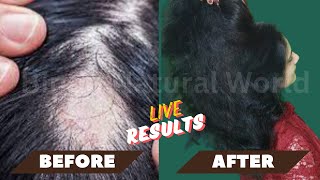 Receding Hairline Regrowth  Hair Regrowth at 40  Regrow Hair After 40 Going Natural from Chemical [upl. by Akram]