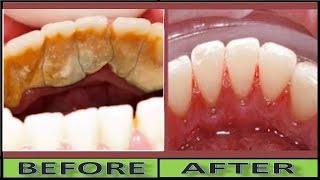 How to Remove TARTAR and Plaque in 3 Minutes Without Scaling Natural WHITE TEETH [upl. by Osnofla]