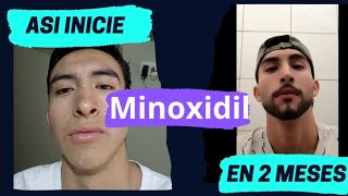 Usando Minoxidil 2 MESES [upl. by Gneh]