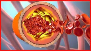 Fibromuskuläre Dysplasie Diagnose und Behandlung [upl. by Nhguahs888]