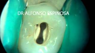 ENDODONCIA CON MICROSCOPIO [upl. by Ninehc468]