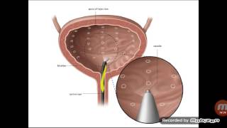 Transitional cell carcinoma [upl. by Aicitel]