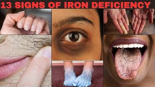 13 Shocking Signs of Iron Deficiency You Need to Know [upl. by Sigismundo]