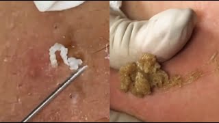 Most Satisfying Blackhead Removal Compilation Ultimate Extraction Videos [upl. by Lexy]