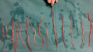 Doctors Remove 14 Roundworms From Woman [upl. by Faludi794]