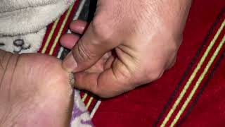 Remove dead skin accumulated heel Removes dead skin feet snakeskin  ingrown 10 ingrown [upl. by Mccallion]