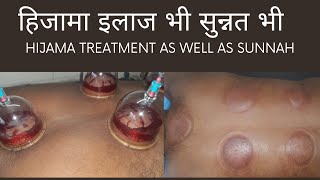 Hijama Treatment at zubi wellness center Malad west Malwani Dr Mohamad Ahamad 98336 29281 [upl. by Kedezihclem]