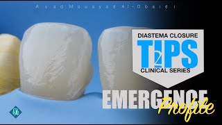 diastema closure technique tips [upl. by Oicnerolf840]