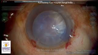 Difficult case by Trainee Live Cataract surgery For training and consultation call 9220001000 [upl. by Bogie432]