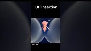 IUD Insertion ye hota h🫣 [upl. by Naols]