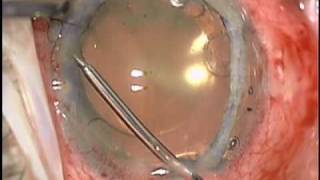 Baseer U Khan MD Dislocated Cataract Extraction CTS Iridodialysis Repair and Pupil Cerclage [upl. by Natlus969]