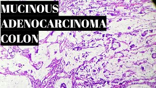 Mucinous Adenocarcinoma Colon Histopathology [upl. by Garbe]