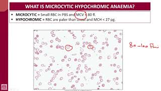 Hematology  1  U7L1  Introduction to microcytic hypochromic anaemias [upl. by Juliano147]