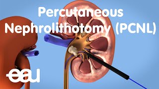 Removal of kidney stones PCNL [upl. by Sutphin]