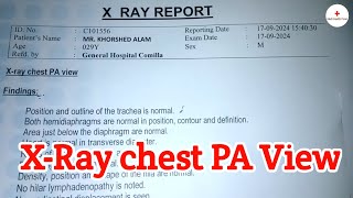 Xray chest PA View Test Review  Investigation  Bangla health tips  Medi Health Point [upl. by Nevart]