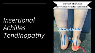 Insertional Achilles Tendinopathy [upl. by Rodenhouse636]