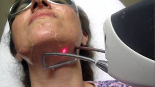 Laser Hair Removal in GlendoraWalnutSan DimasArcadiaWest CovinaMonroviaPasadena [upl. by Tija]