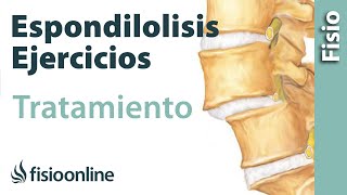 Espondilolisis y espondilolistesis  Tratamiento con ejercicios automasajes y estiramientos [upl. by Kilah945]