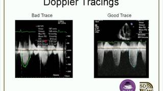 Optimizing Your Echo Images amp Doppler Evaluations webcast [upl. by Yelekalb]