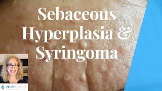 SEBACEOUS HYPERPLASIA VS SYRINGOMA  BEST REMOVAL PROCEDURES [upl. by Damha]