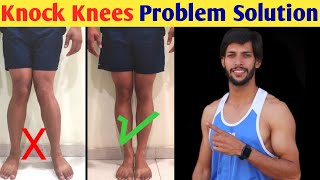 How To Fix Knock Knees at Home  Knock knee Problem solution [upl. by Alvarez]