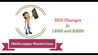 ECG Changes in LBBB and RBBB [upl. by Ariik]