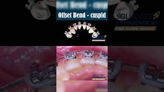 OFFSET BEND  CUSPID  ORTHODONTIC TIPS Shorts [upl. by Ttessil]