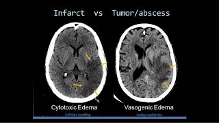 Intro to Head CT Part II Evaluation of Ischemic Stroke [upl. by Love705]