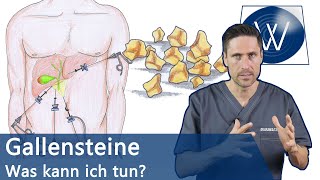 Gallensteine Was nun Typische Symptome Alles zur Entstehung amp Tipps zur natürlichen Entfernung [upl. by Adnama]