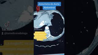 Angiotomografia de aorta abdominal [upl. by Tibbetts]