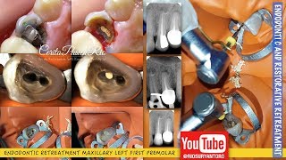 ENDODONTIC Retreatment one curve micromega gutta percha removal rebilda DC [upl. by Calista]