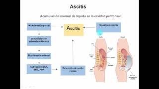 Complicaciones del daño hepático [upl. by Rebe]