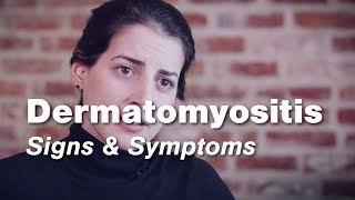 Dermatomyositis – Signs amp Symptoms  Johns Hopkins [upl. by Nyrem]