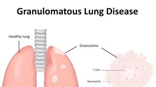 Granulomatous diseases of Lung Introduction [upl. by Kaja]