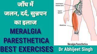 MERALGIA PARESTHETICA TREATMENT IN HINDI  OUTER THIGH NUMBNESS AND TINGLING TREATMENT EXERCISES [upl. by Wolfie139]