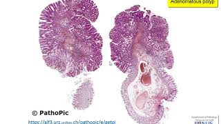 Colon Familial Adenomatous Polyposis [upl. by Malim]