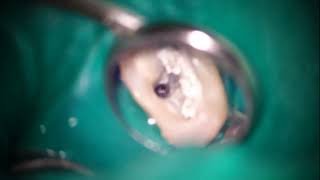 Removal of a broken ProTaper S1 with HyFlex EDM OneFile Dr Terauchi [upl. by Whitehouse]