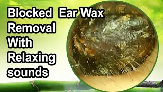 Blocked ear wax removal with relaxing sounds [upl. by Seugram]