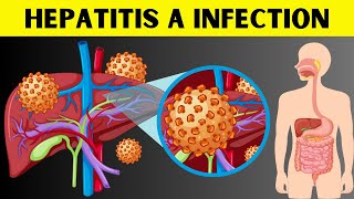 Hepatitis A Infection  Signs amp Symptoms Risk Factors Virology Diagnosis And Treatment [upl. by Natsuj]