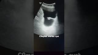 Complex ovarian cyst ultrasonography gynaecology [upl. by Jeanne]