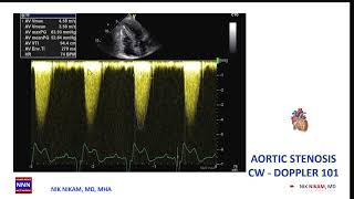 AORTIC STENOSIS DOPPLER 101 [upl. by Spohr608]