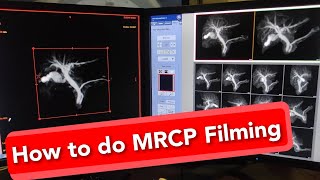 MRCP MRI scan Filming Protocol [upl. by Souza]