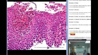 Eosinophilic Esophagitis Megan Eyunni [upl. by Pavier]