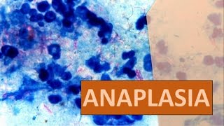 Anaplasia  PATOLOGIA 1 [upl. by Fanning]