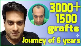 Hair Transplantation Result in 6 Years 4500 DHTFUE grafts NW 34 at 6 years Drs SethiBansal [upl. by Annhoj]