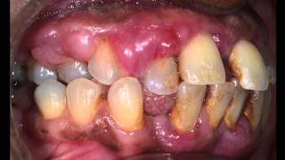 Treatment of Advanced Gum disease [upl. by Lindberg]