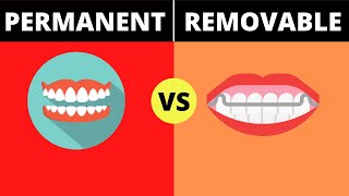 Permanent Retainers vs Removable Retainers [upl. by Ayocal500]